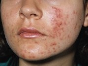 Acne Vulgaris Acne Vulgaris