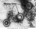 Siêu vi khuẩn Herpes Zoster Siêu vi khuẩn Herpes Zoster
