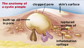 Anatomy of a cystic pimple Anatomy of a cystic pimple