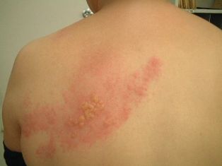 Shingles ở lưng Shingles ở lưng