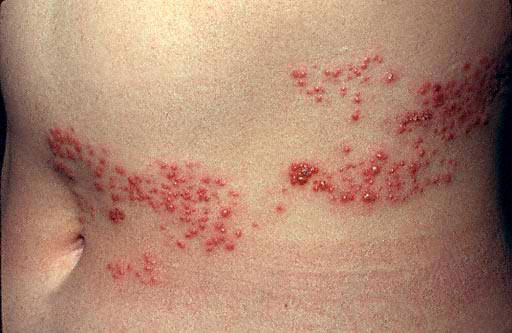 Shingles vùng bụng Shingles vùng bụng