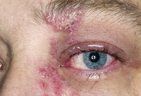 Shingles vùng mắt Shingles vùng mắt